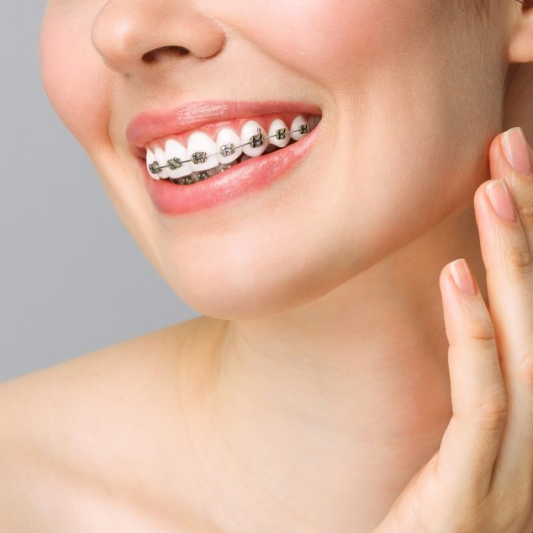 Orthodontic,Dental,Care,Concept.,Woman,Healthy,Smile,Close,Up.,Closeup
